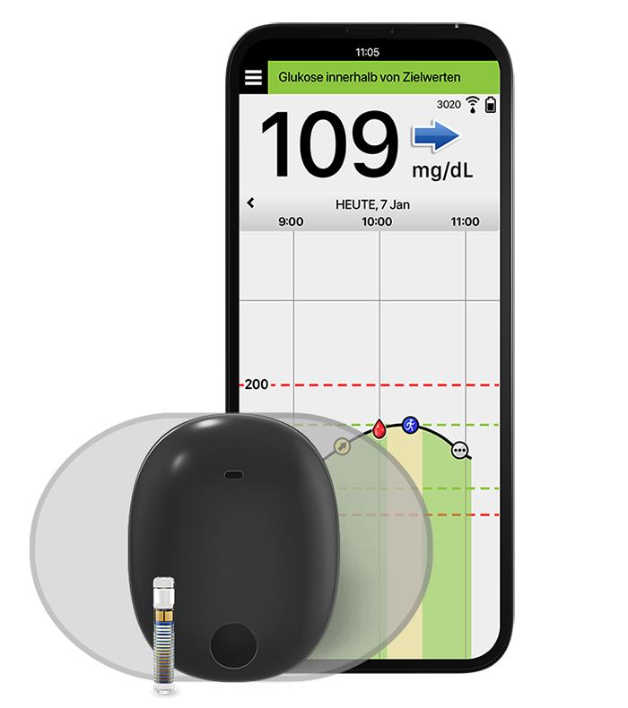 Eversense CGM